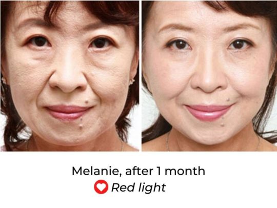 Led Light Facial Before And After E1610452535521 540x406 